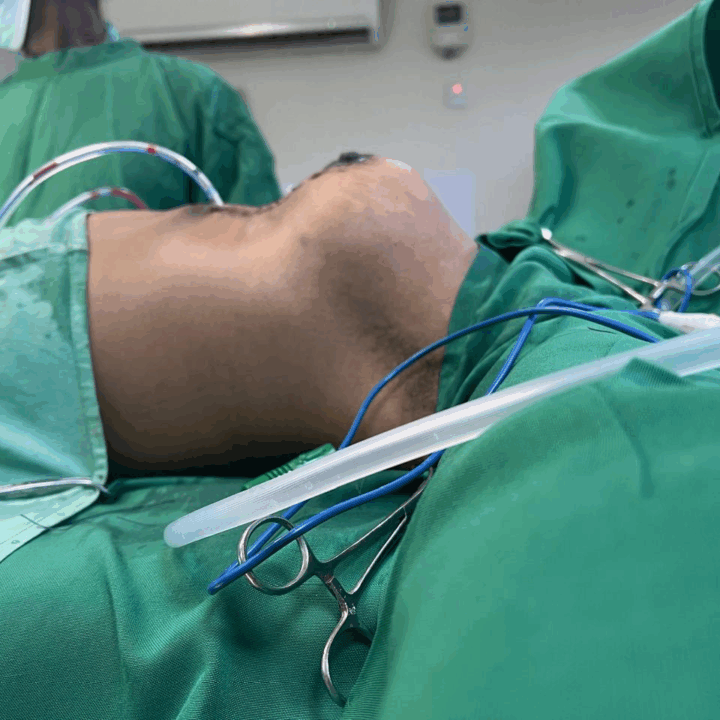 Reduction Mammoplasty