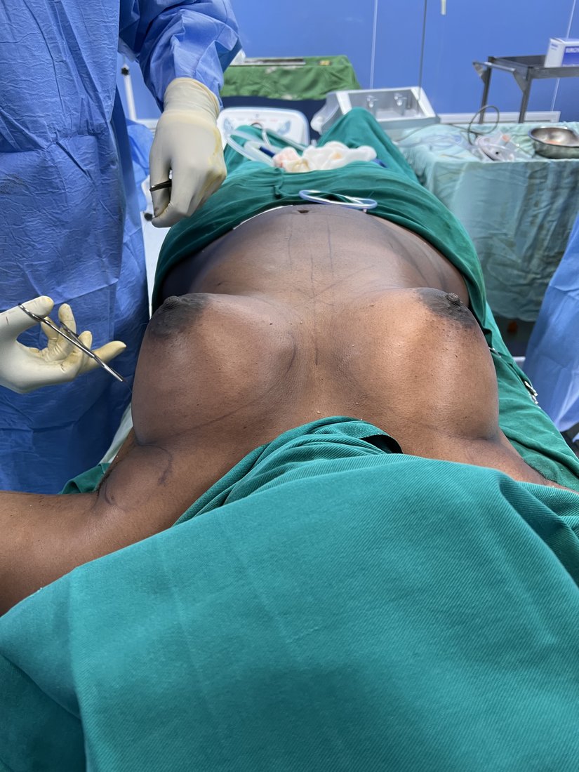 Breast augmentation photo 5