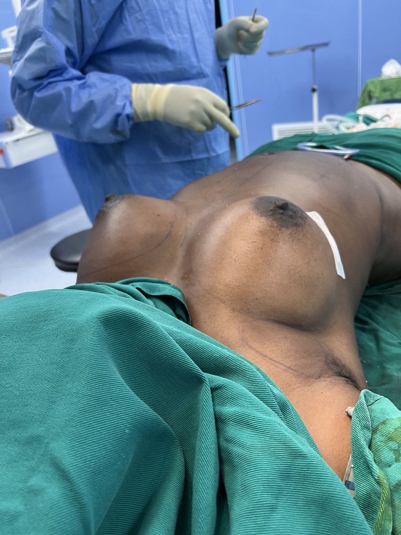 Breast augmentation photo 6