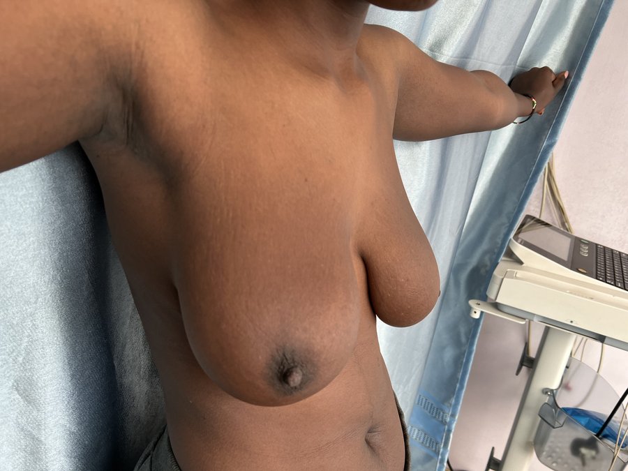 Breast augmentation photo 15