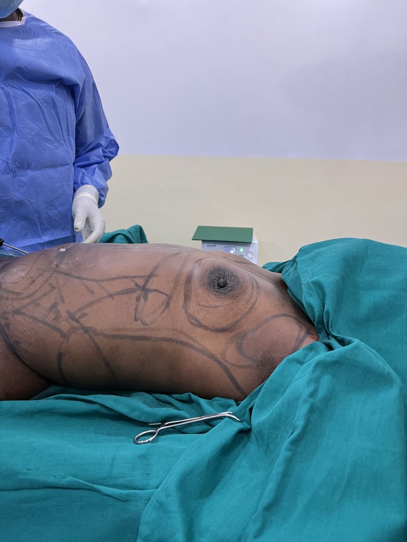 Breast augmentation photo 18