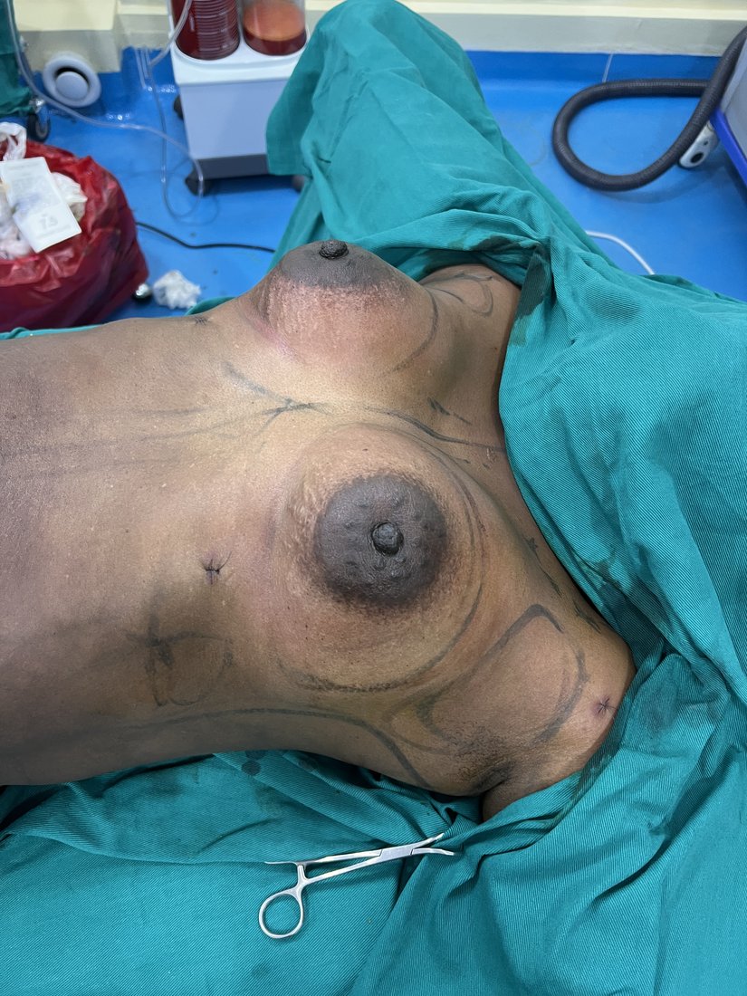 Breast augmentation photo 22