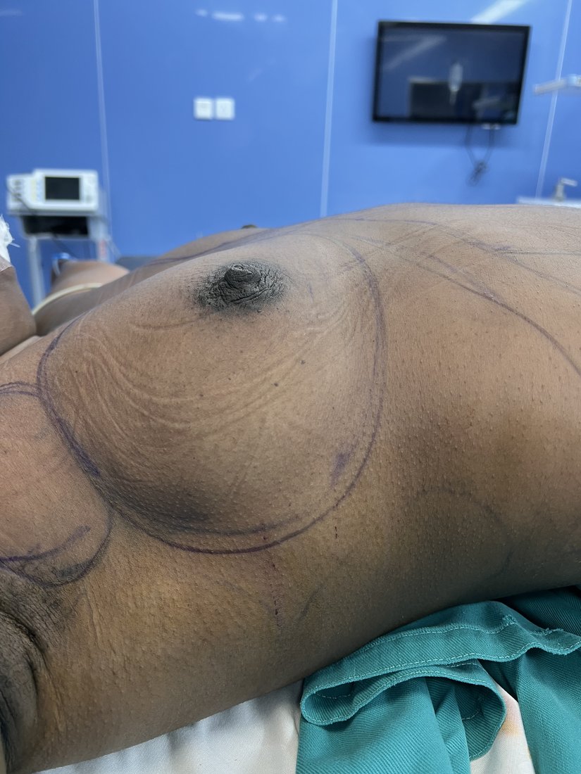 Breast augmentation photo 27