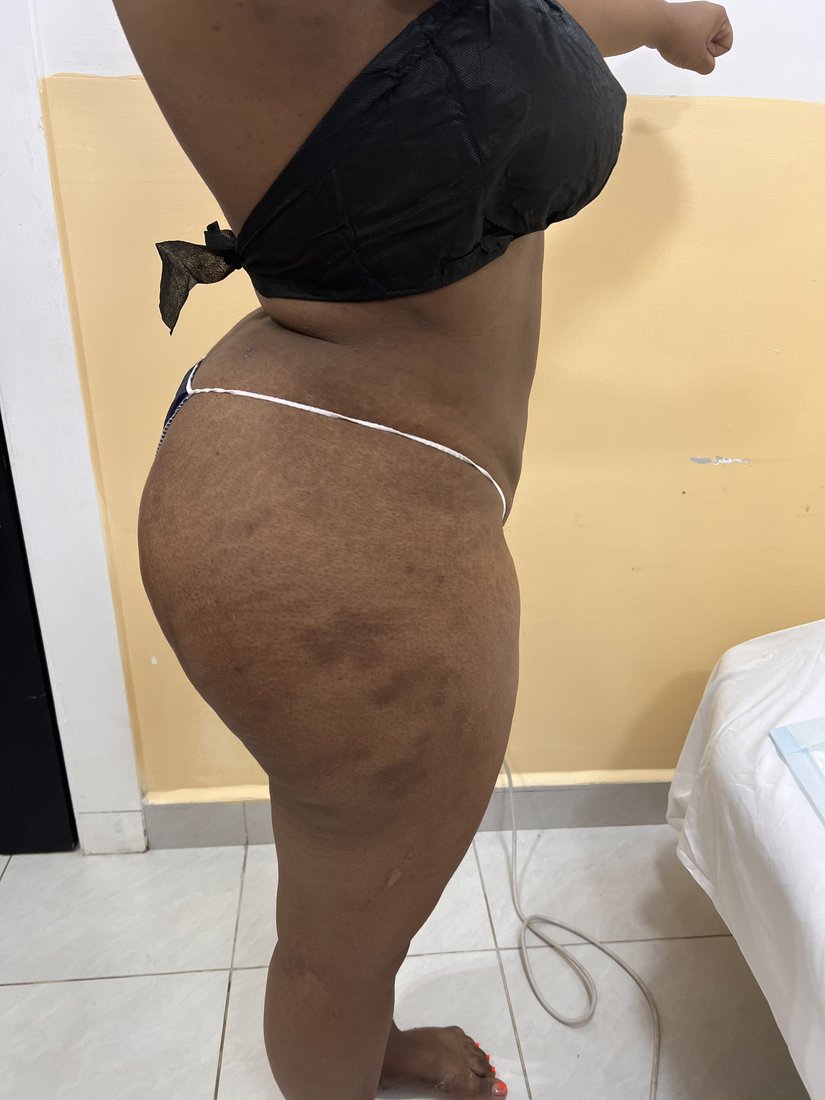 Brazilian Butt Lift photo 6