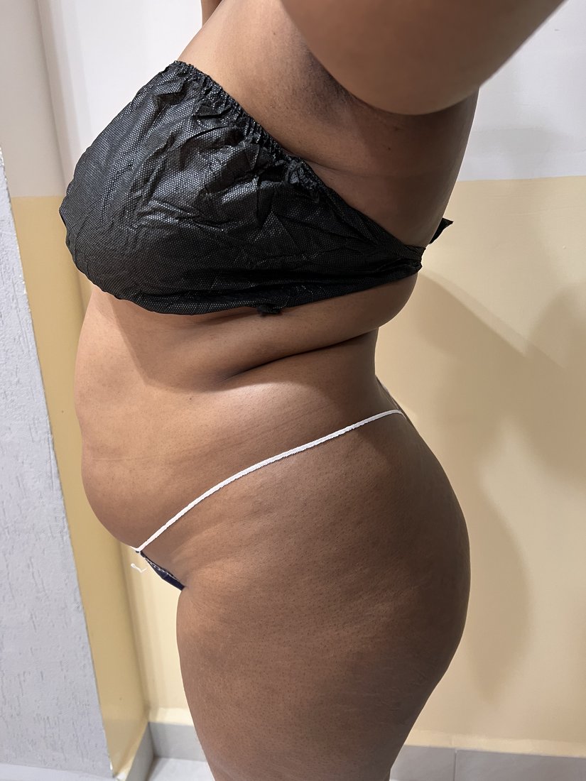 Brazilian Butt Lift photo 13