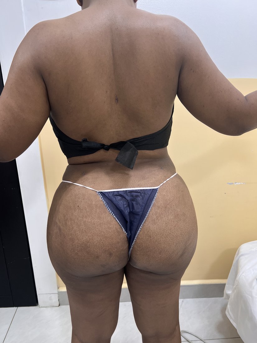 Brazilian Butt Lift photo 15
