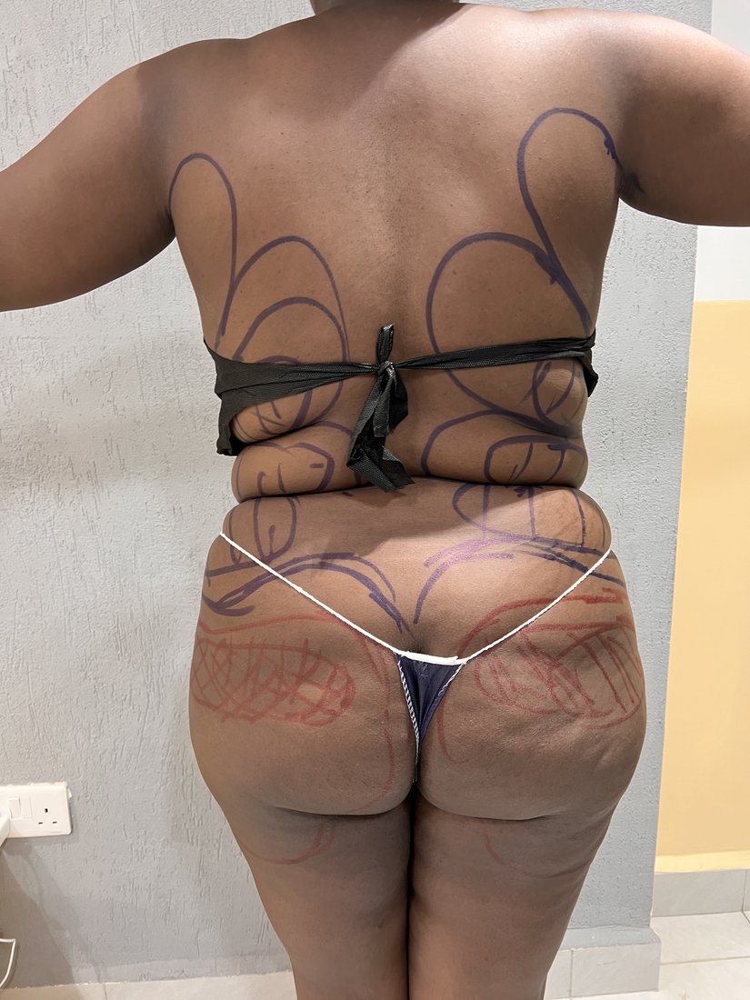 Brazilian Butt Lift photo 17