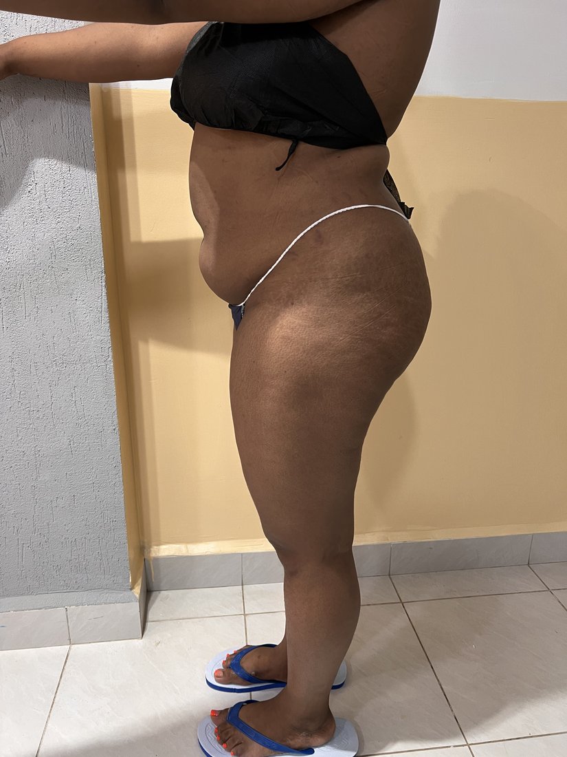 Brazilian Butt Lift photo 18