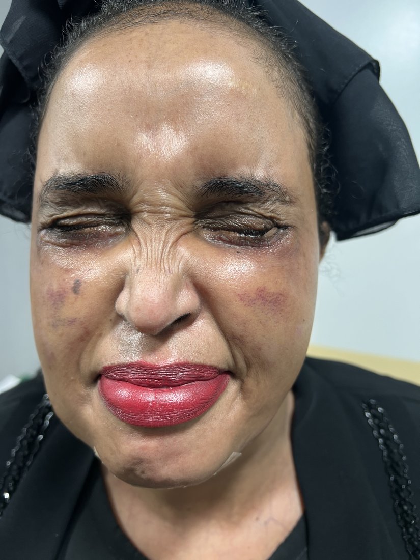 Blepharoplasty