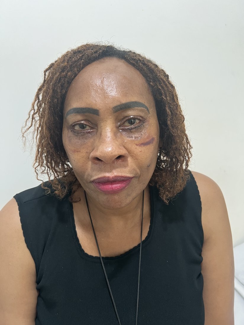 Blepharoplasty photo 4