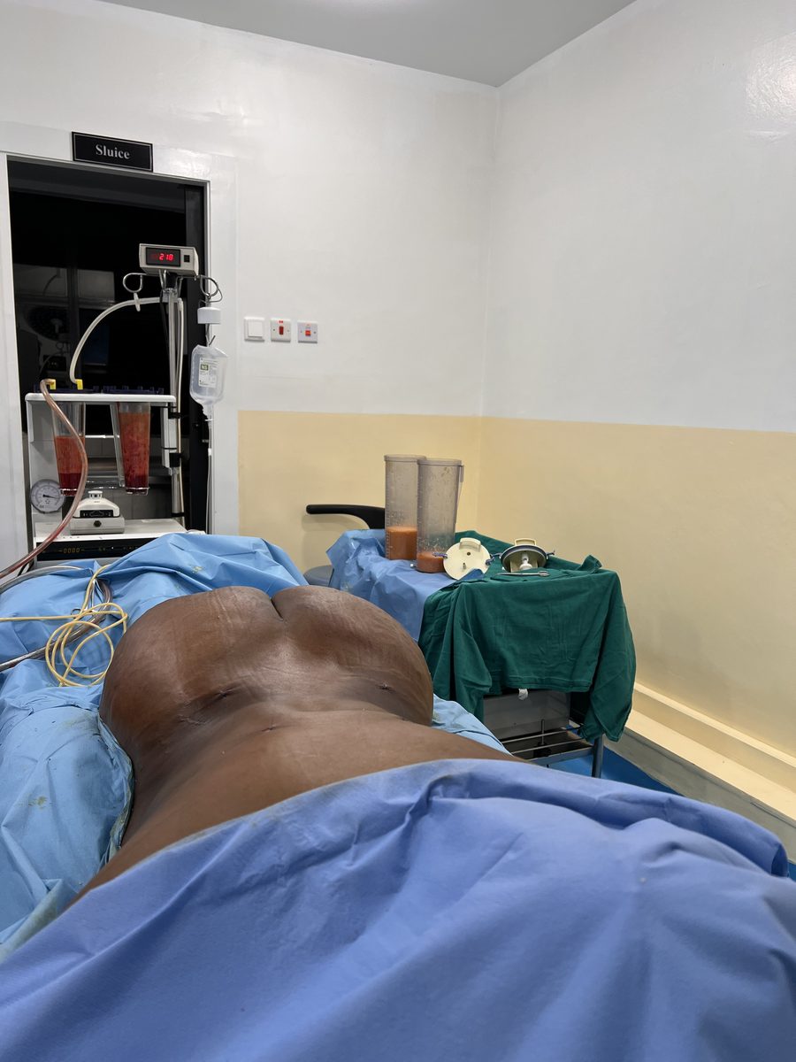 Liposuction procedure at Truffel Healthcare Kilimani