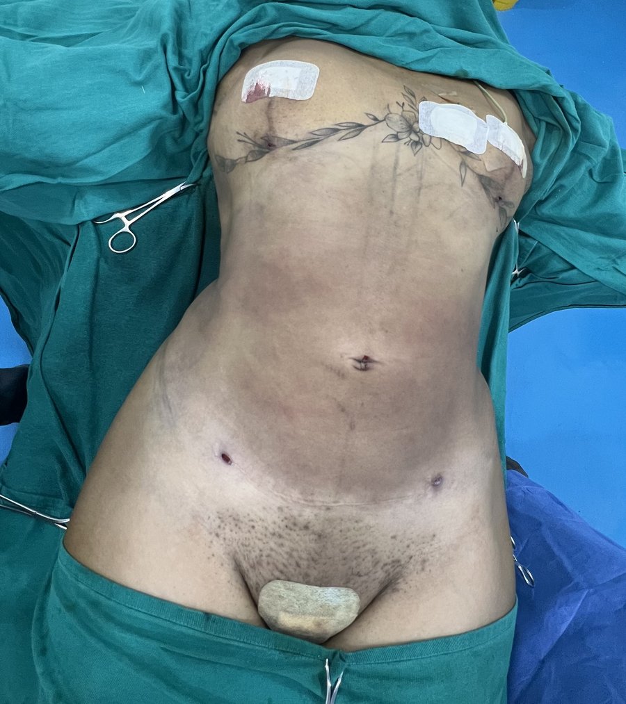 Liposuction photo 9