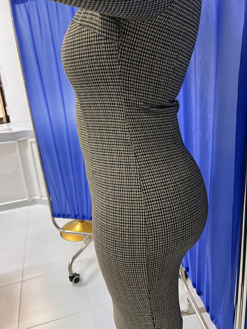 Liposuction photo 11