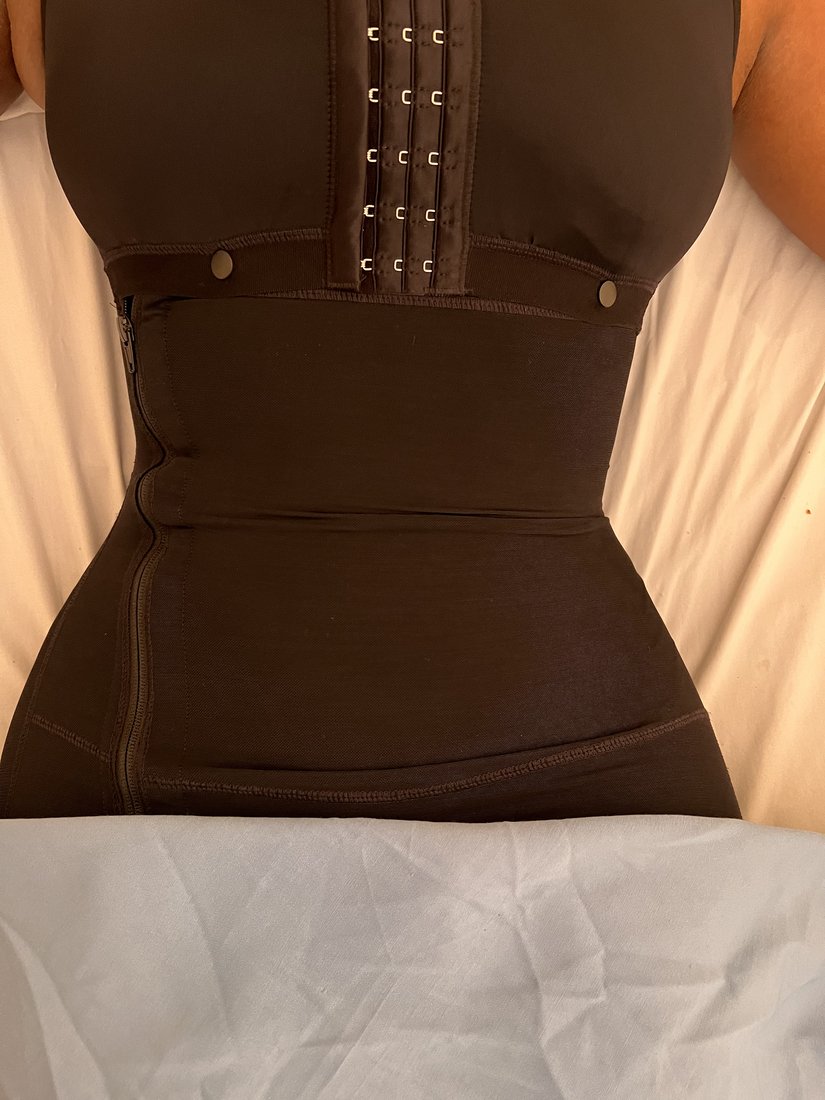Liposuction photo 12