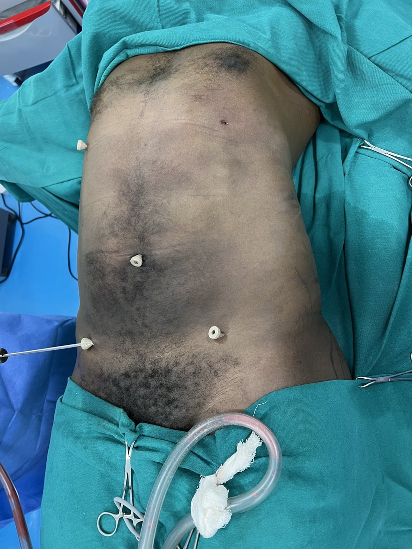 Liposuction photo 13