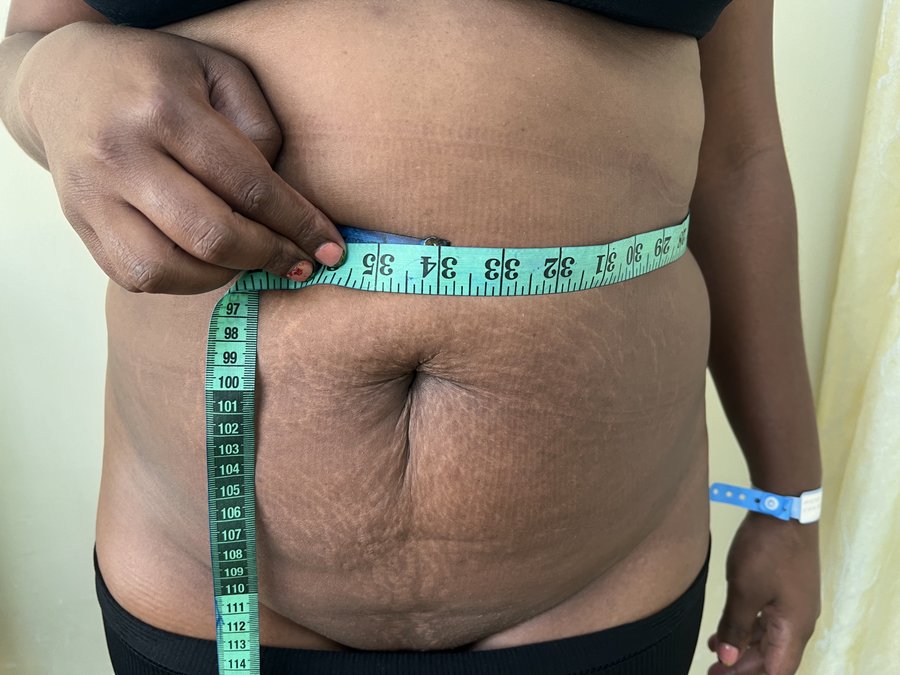 Liposuction photo 23