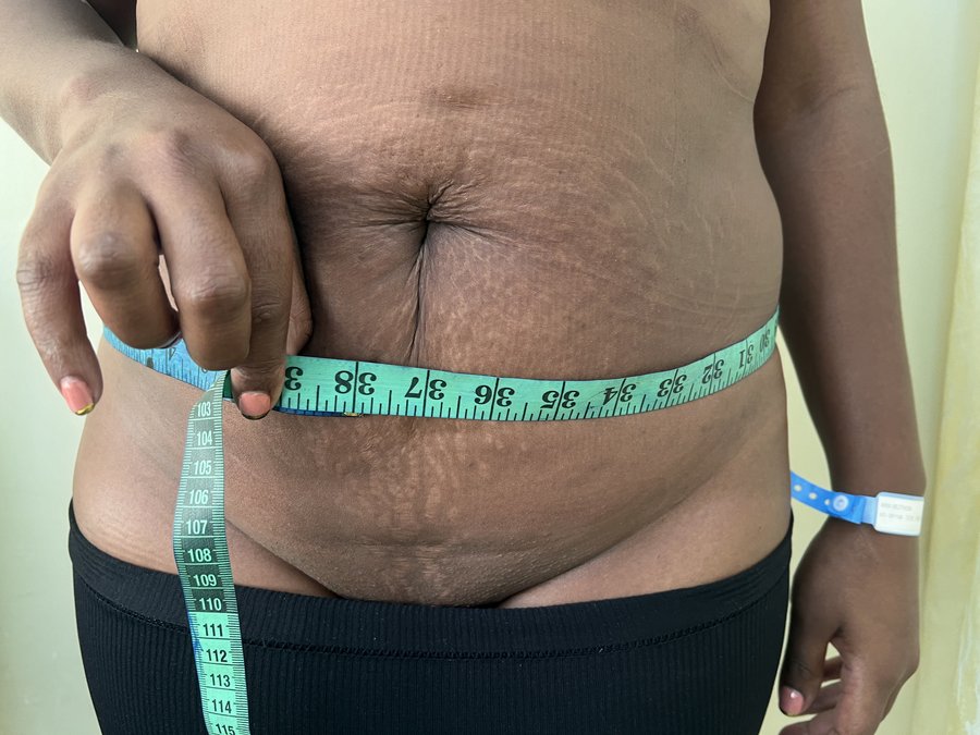 Liposuction photo 29