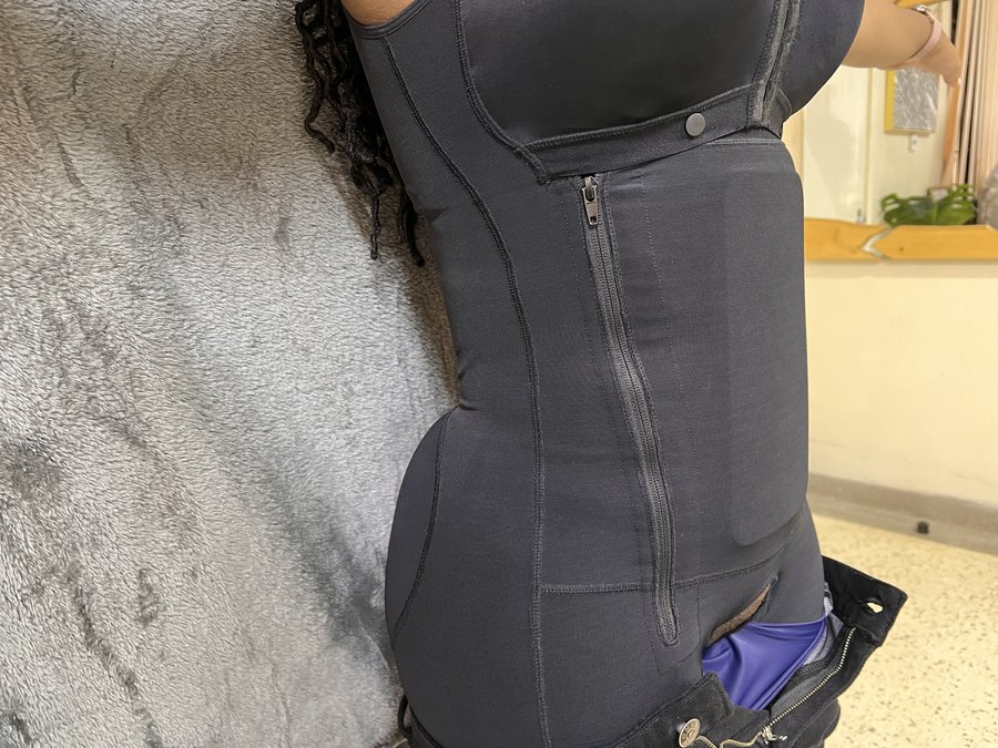 Liposuction photo 30