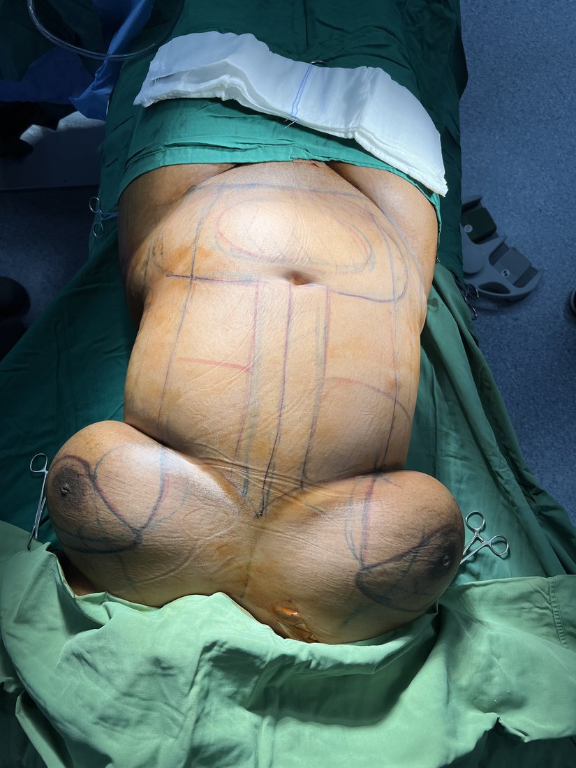 Liposuction photo 31