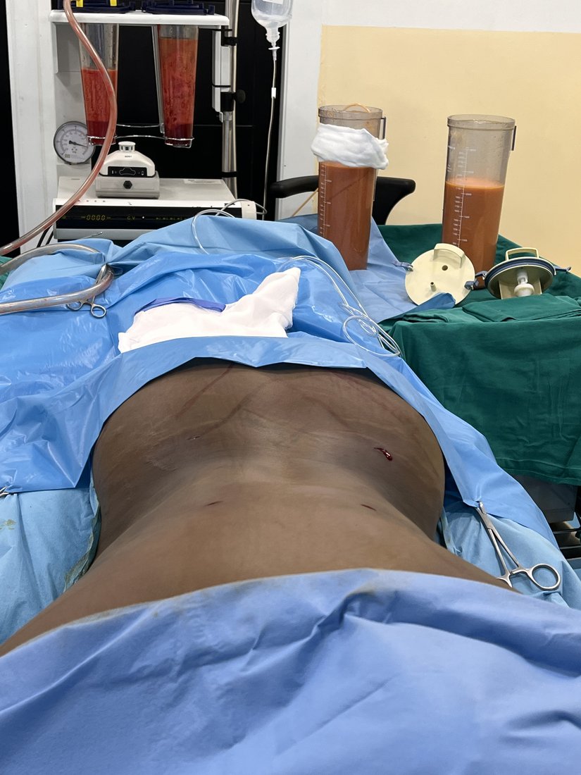 Liposuction photo 32
