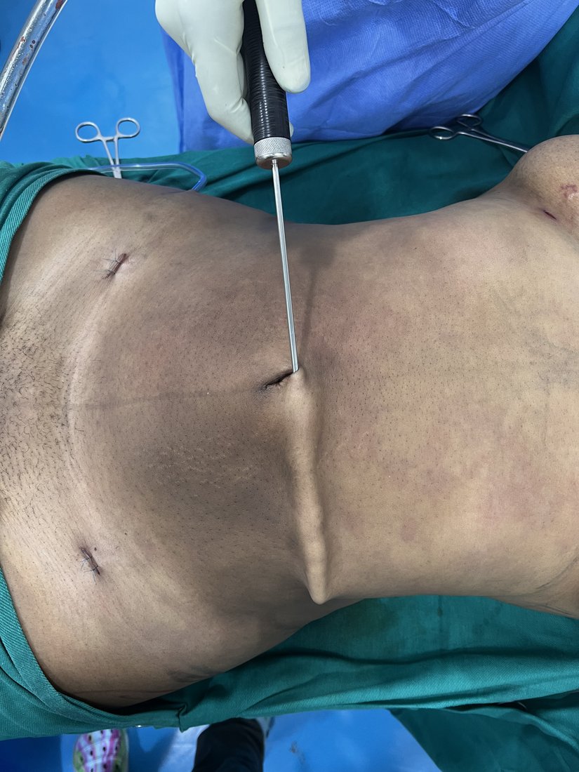 Liposuction photo 33