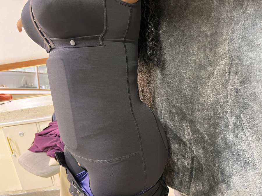 Liposuction photo 34