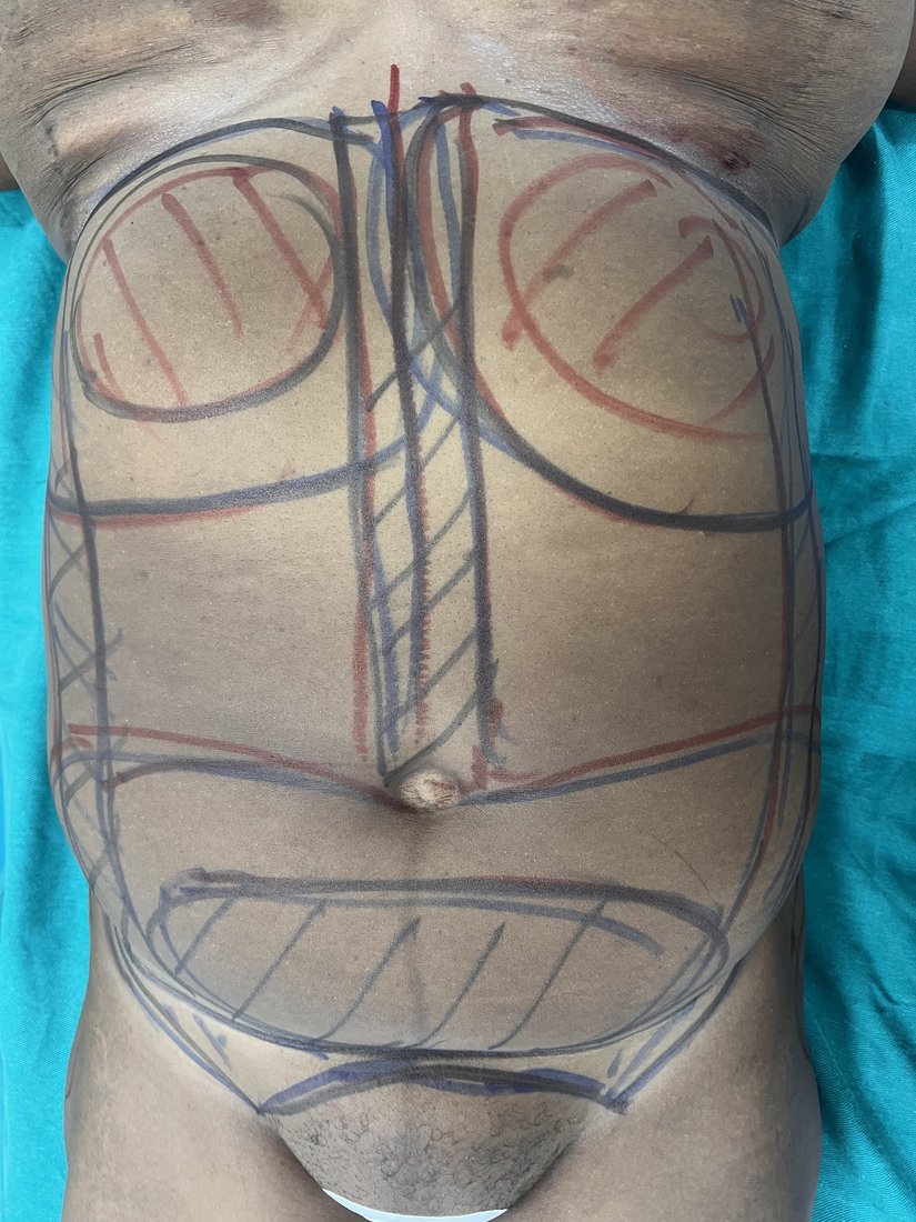 Liposuction photo 37