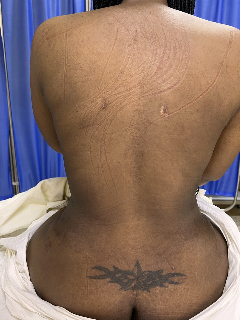 Liposuction photo 38