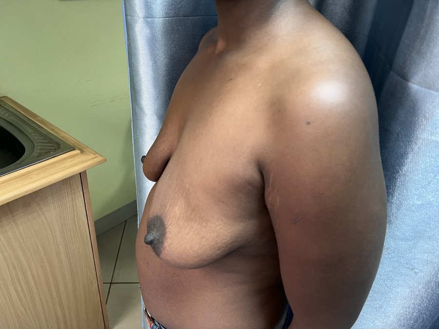 Mastopexy photo 6