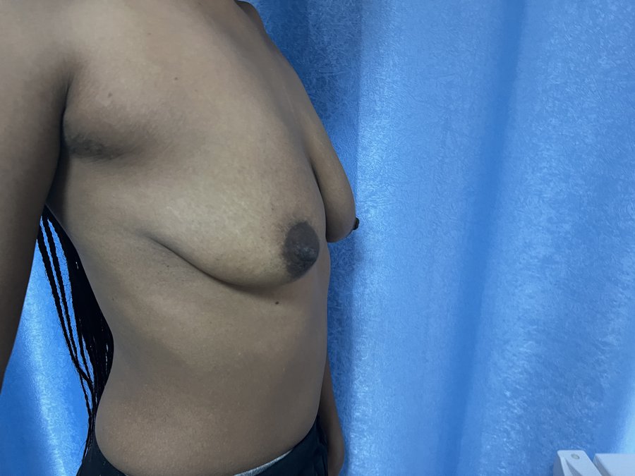Mastopexy photo 7