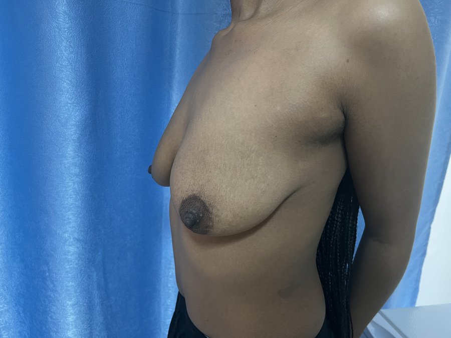 Mastopexy photo 12