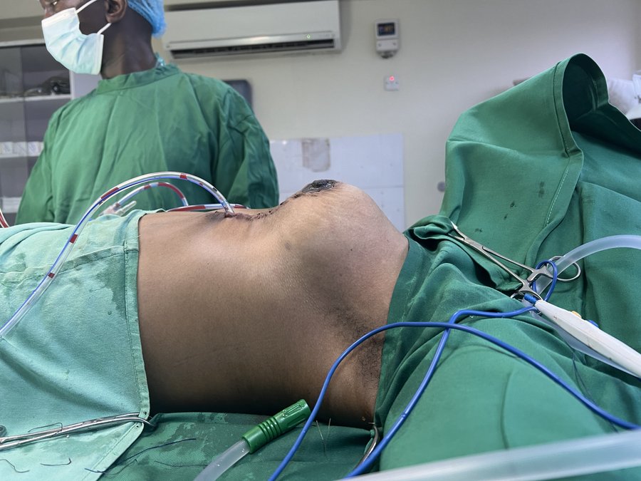 Mastopexy photo 16