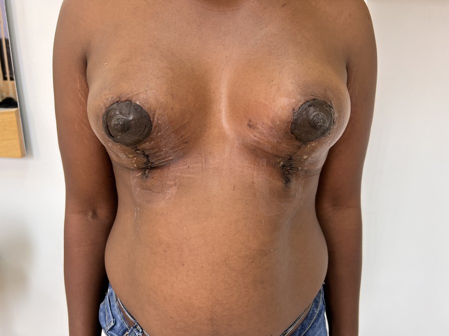 Mastopexy photo 23