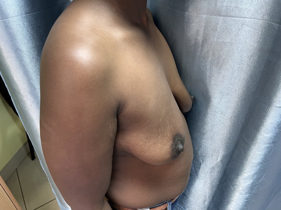 Mastopexy photo 24