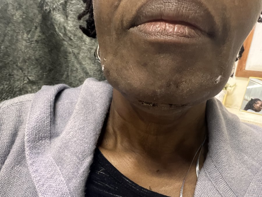 Neck Lift