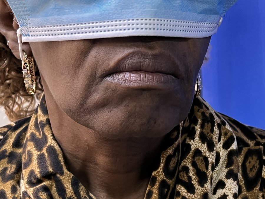 Neck lift photo 3