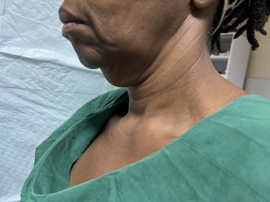 Neck lift photo 4