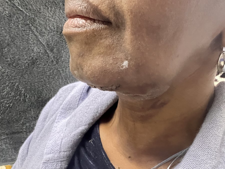 Neck lift photo 7