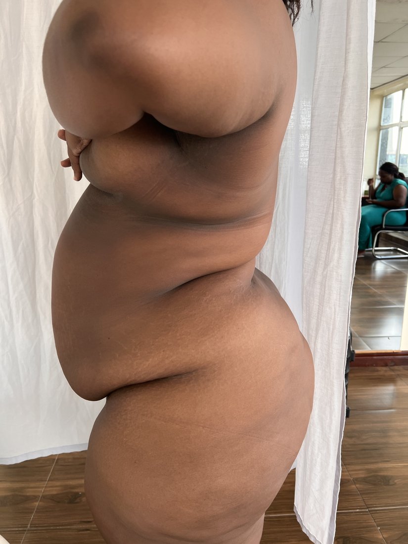 Breast reduction photo 1