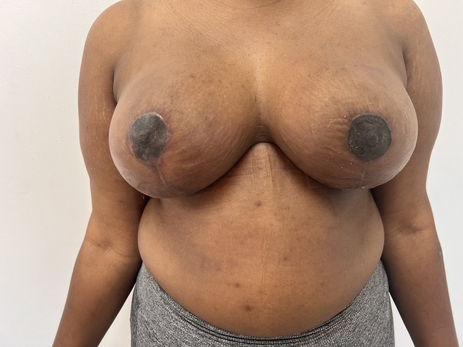 Breast reduction photo 16