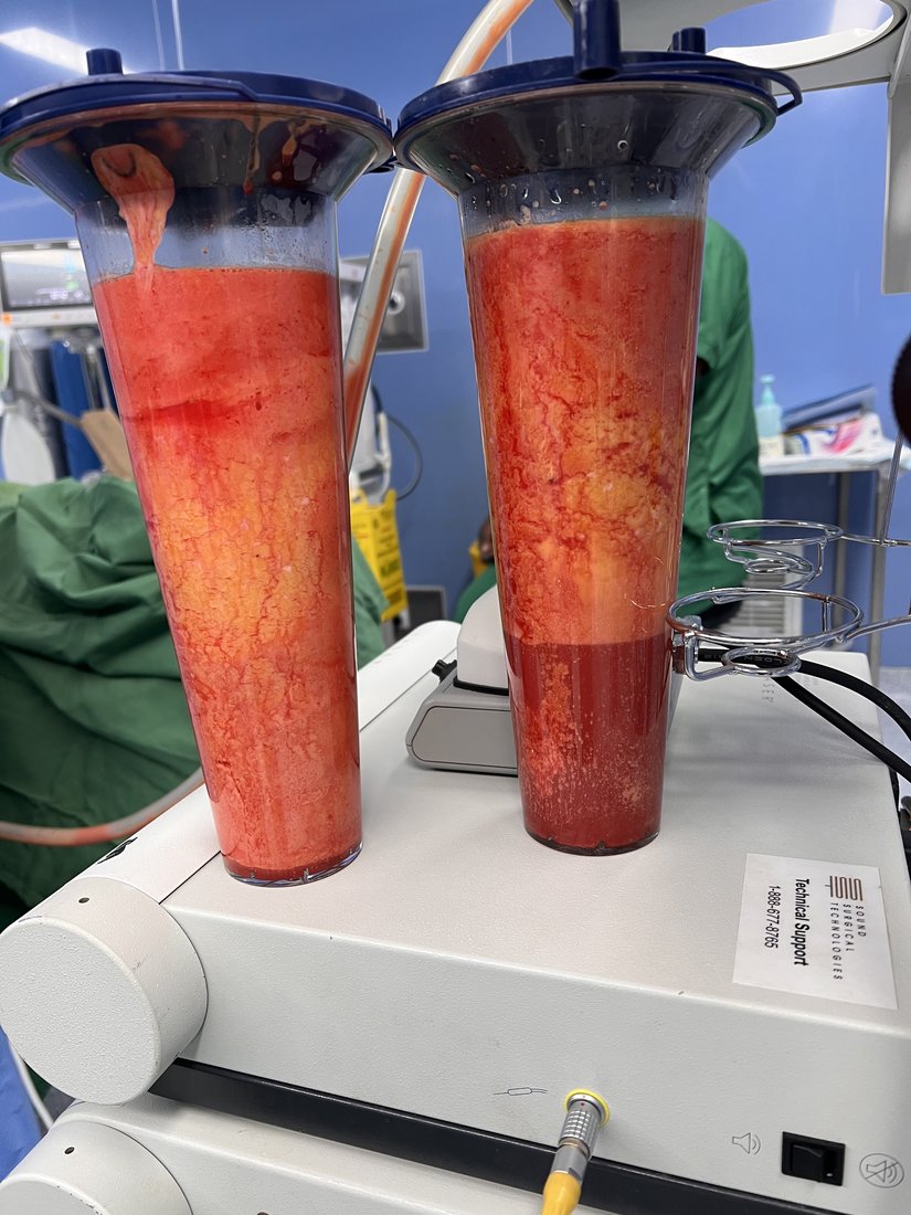 Regional liposuction photo 1