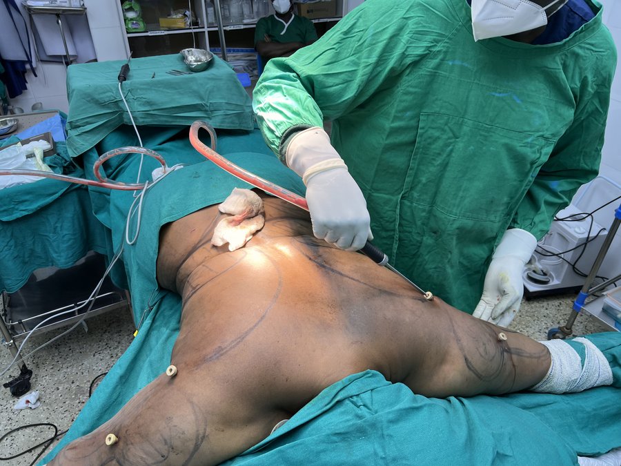 Regional liposuction photo 2
