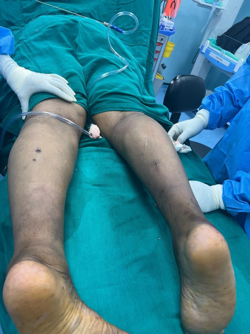 Regional liposuction photo 3