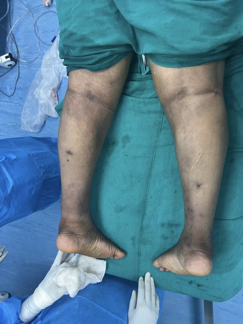 Regional liposuction photo 4
