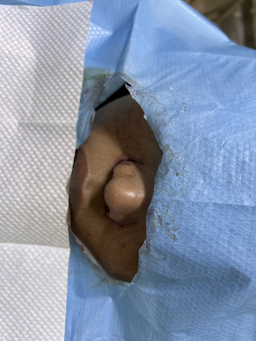 Rhinoplasty