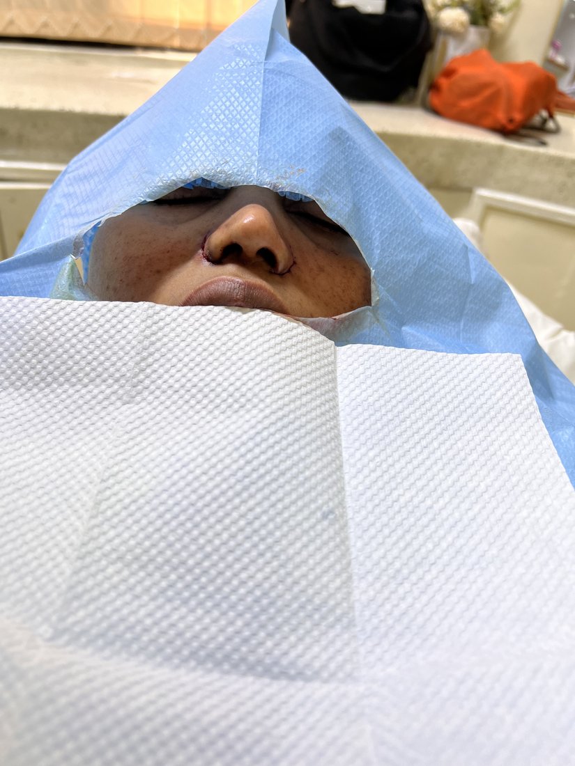 Rhinoplasty photo 2