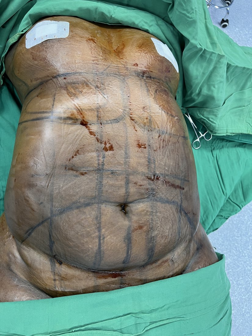 Tummy tuck photo 1