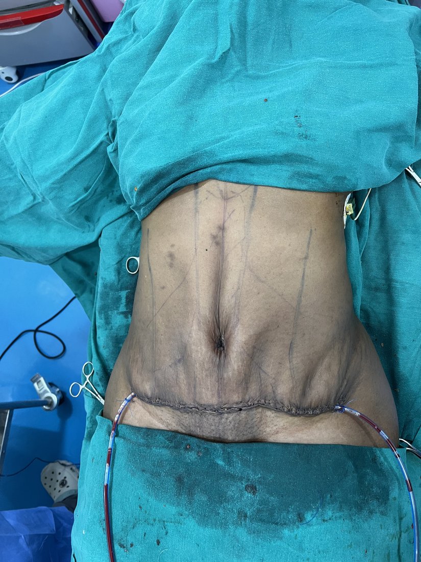 Tummy tuck photo 5