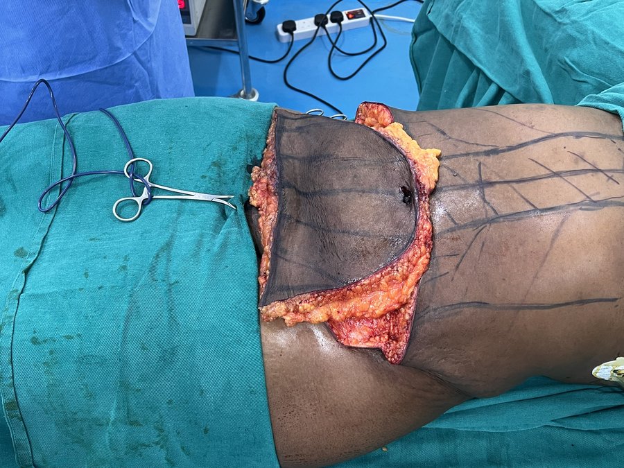 Tummy tuck photo 9