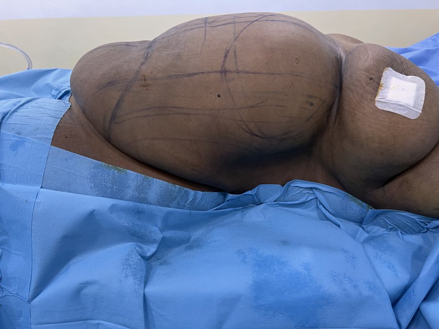 Tummy tuck photo 11